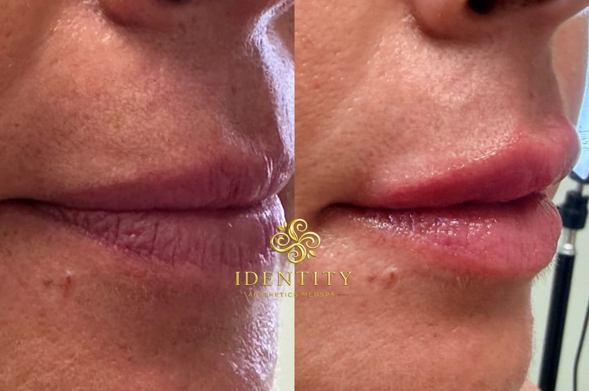 Lip enhancement case one before and after