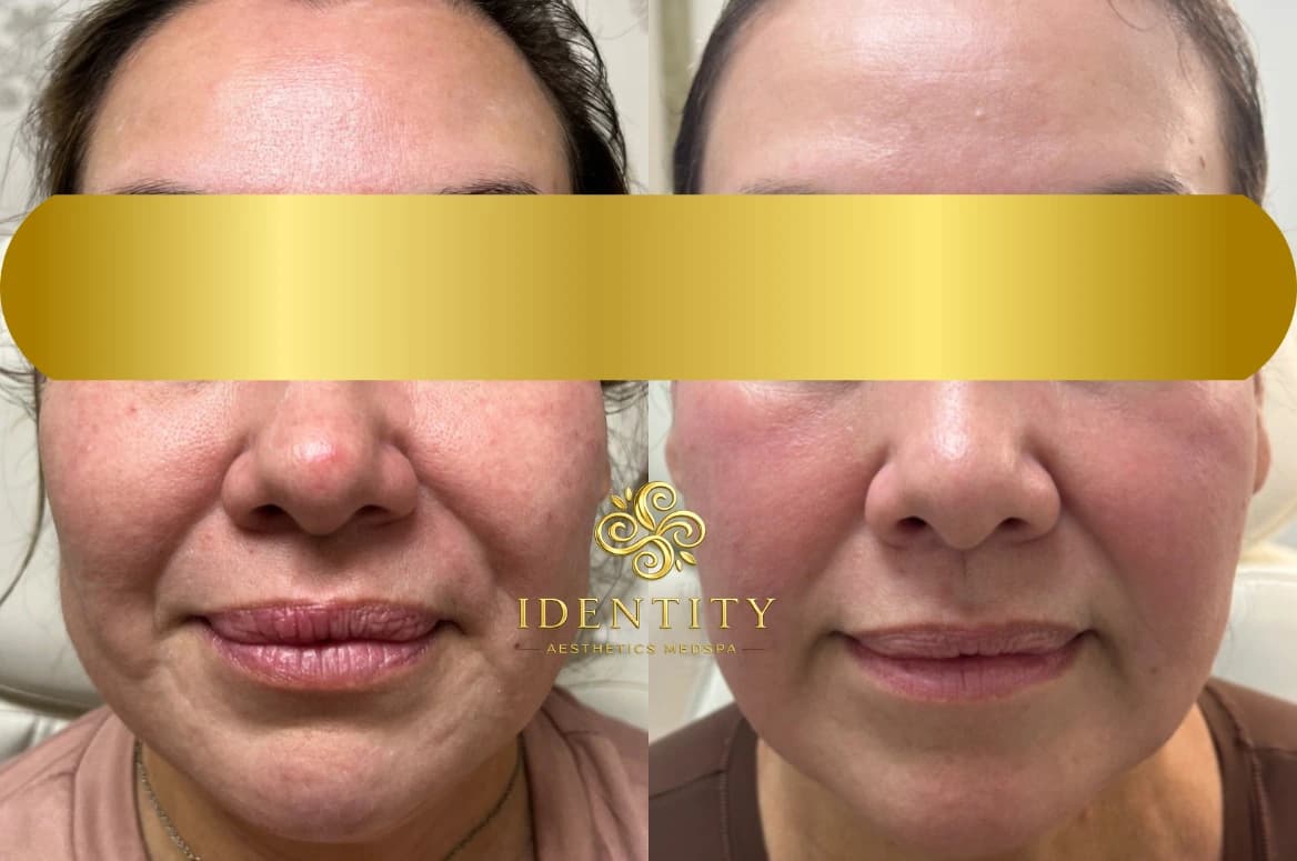 MicroLaserPeel case one before and after